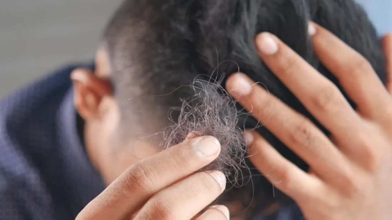 155 Kişi Saç Dökülmesi Sorunu Yaşıyor