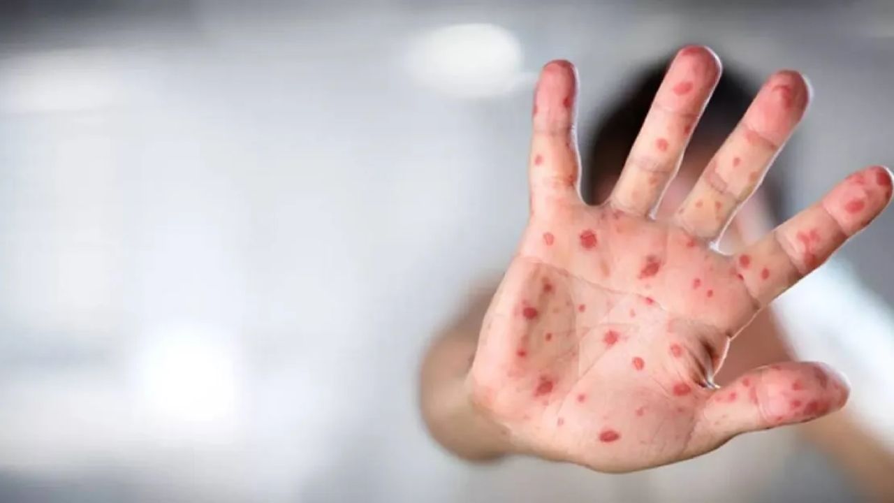 Azerbaycan'da İlk Mpox Vakası Tespit Edildi