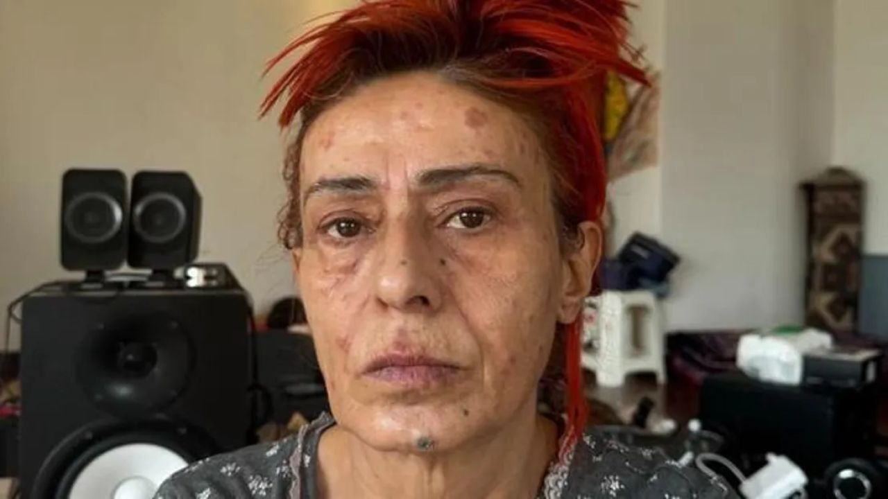 Yıldız Tilbe kimyasal yanık geçirdi