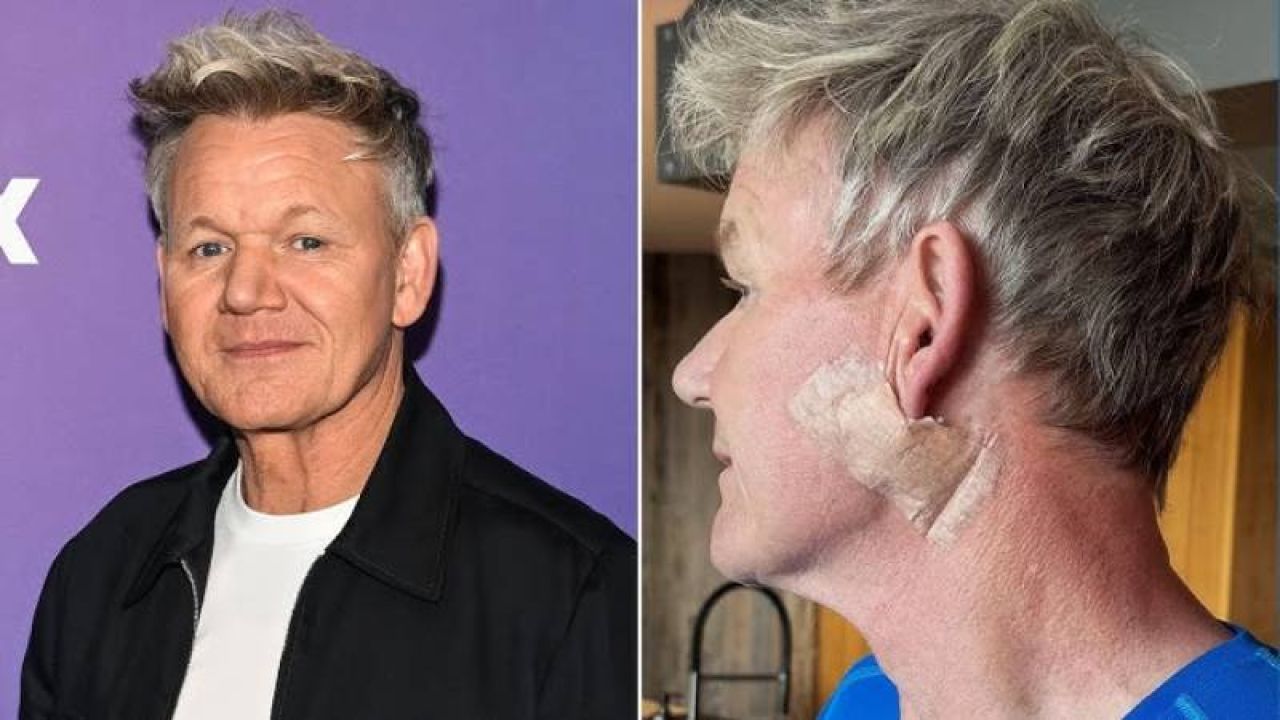 Gordon Ramsay Hastalığını İlk Kez Açıkladı: Takipçilerini Uyardı
