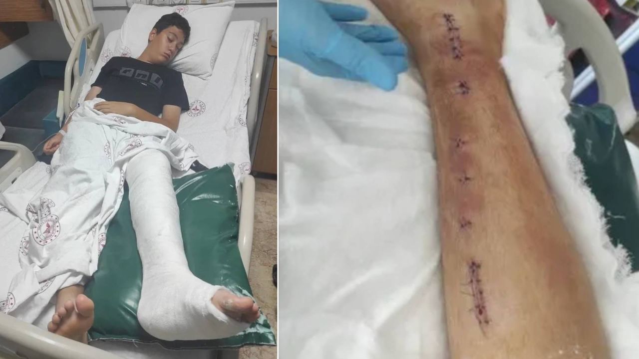 Akran Zorbalığı Faciası: 9. Sınıf Öğrencinin Ayağı Kırıldı, Okul Aileyi Suçladı